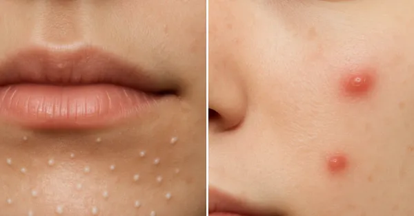 Side-by-side comparison of skin purging versus a breakout reaction